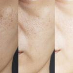 Exactly How to Look Younger by Banishing Loosened Old and Wrinkled Skin?